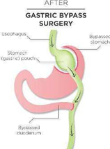 Minimal Invasive Bariatric Surgery