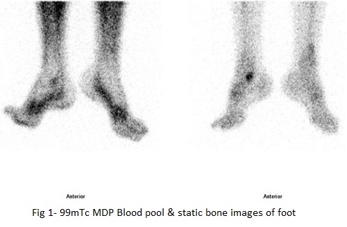 BONE SPECT-CT imaging of obscure foot and ankle pain 01