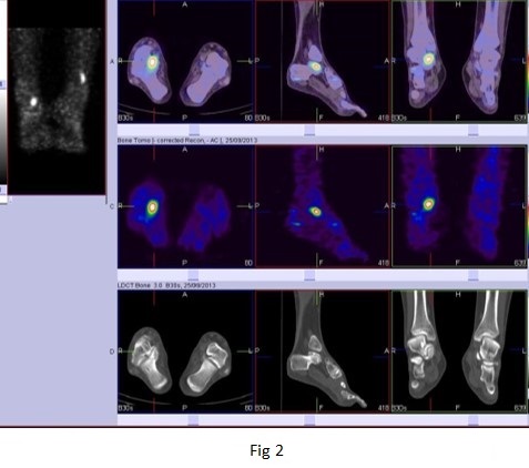 BONE SPECT-CT imaging of obscure foot and ankle pain 02
