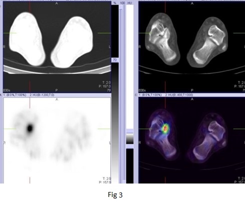 BONE SPECT-CT imaging of obscure foot and ankle pain 03