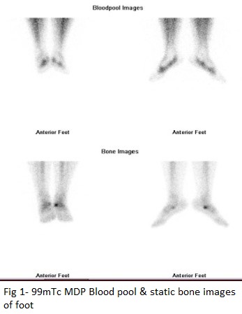 BONE SPECT-CT imaging of obscure foot and ankle pain 04