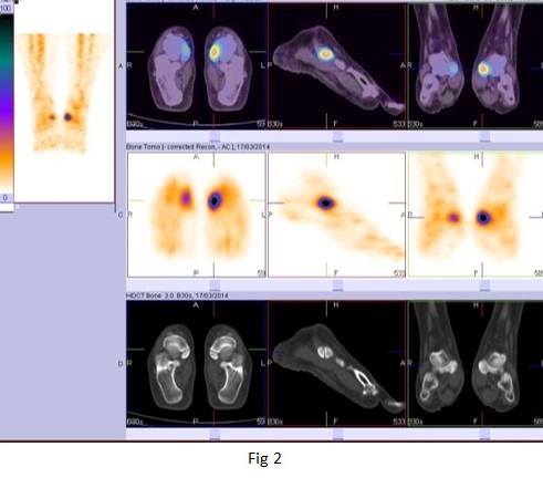 BONE SPECT-CT imaging of obscure foot and ankle pain 05