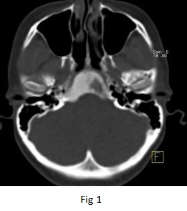 Fibrous Dysplasia of the Clivus skull bone 02