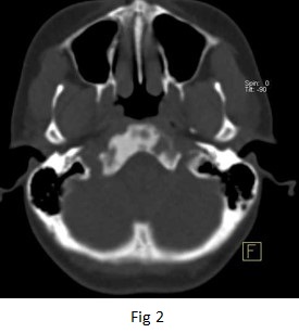 Fibrous Dysplasia of the Clivus skull bone 03
