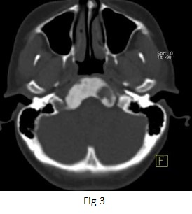 Fibrous Dysplasia of the Clivus skull bone 04