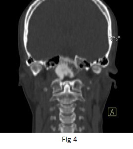 Fibrous Dysplasia of the Clivus skull bone 05