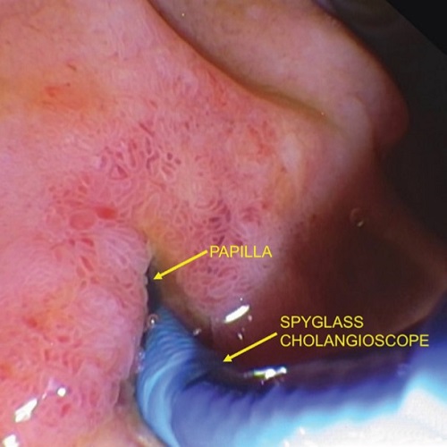 First ever Cholangioscopy (Endoscopy inside the bile duct) at Al Zahra Hospital, Sharjah 04