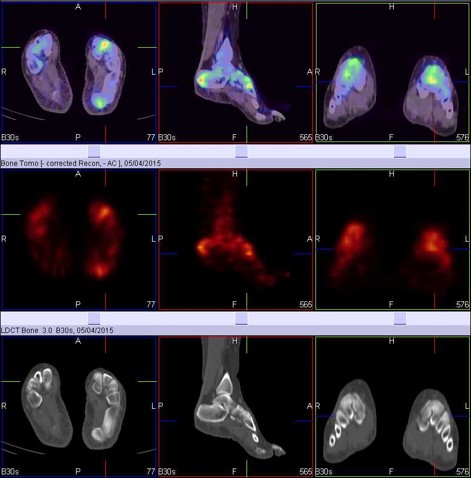 Hybrid Bone SPECT/CT imaging of the Foot and Ankle: Potential Clinical Applications in Foot Pain 01