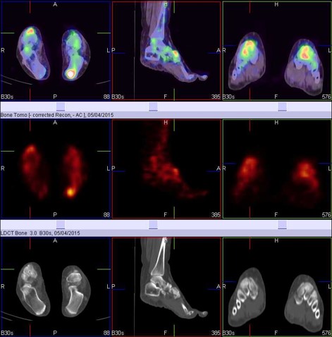 Hybrid Bone SPECT/CT imaging of the Foot and Ankle: Potential Clinical Applications in Foot Pain 02