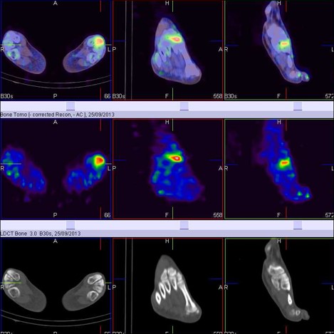 Hybrid Bone SPECT/CT imaging of the Foot and Ankle: Potential Clinical Applications in Foot Pain 06