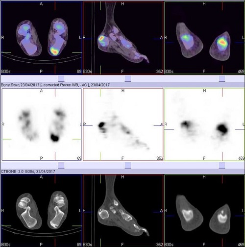 Hybrid Bone SPECT/CT imaging of the Foot and Ankle: Potential Clinical Applications in Foot Pain 07