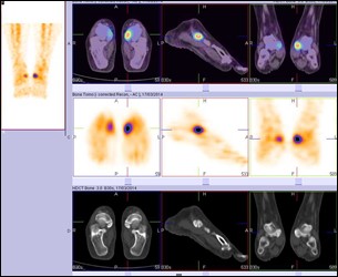 Hybrid Bone SPECT/CT imaging of the Foot and Ankle: Potential Clinical Applications in Foot Pain 09