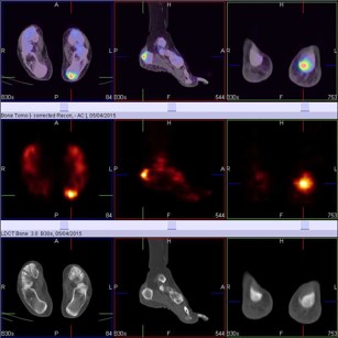Hybrid Bone SPECT/CT imaging of the Foot and Ankle: Potential Clinical Applications in Foot Pain 10