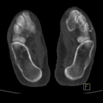 Hybrid Bone SPECT/CT imaging of the Foot and Ankle: Potential Clinical Applications in Foot Pain 11