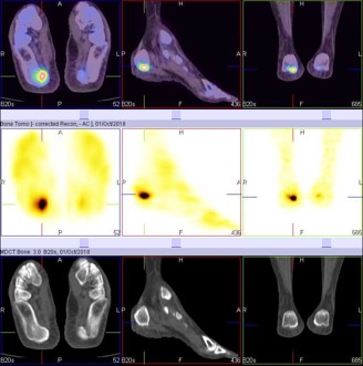 Hybrid Bone SPECT/CT imaging of the Foot and Ankle: Potential Clinical Applications in Foot Pain 12
