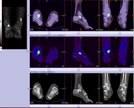 Hybrid Bone SPECT/CT imaging of the Foot and Ankle: Potential Clinical Applications in Foot Pain 13
