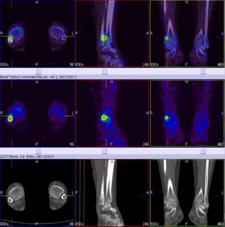 Hybrid Bone SPECT/CT imaging of the Foot and Ankle: Potential Clinical Applications in Foot Pain 14
