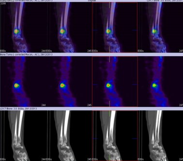 Hybrid Bone SPECT/CT imaging of the Foot and Ankle: Potential Clinical Applications in Foot Pain 15