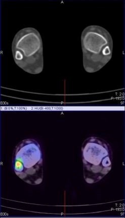 Hybrid Bone SPECT/CT imaging of the Foot and Ankle: Potential Clinical Applications in Foot Pain 16