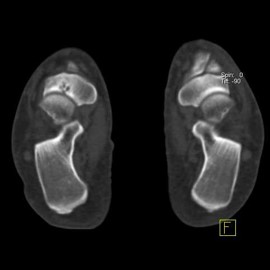 Hybrid Bone SPECT/CT imaging of the Foot and Ankle: Potential Clinical Applications in Foot Pain 17