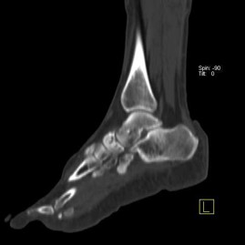 Hybrid Bone SPECT/CT imaging of the Foot and Ankle: Potential Clinical Applications in Foot Pain 18