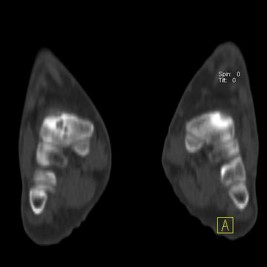 Hybrid Bone SPECT/CT imaging of the Foot and Ankle: Potential Clinical Applications in Foot Pain 19