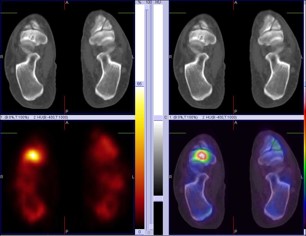 Hybrid Bone SPECT/CT imaging of the Foot and Ankle: Potential Clinical Applications in Foot Pain 20