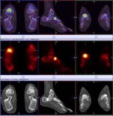 Hybrid Bone SPECT/CT imaging of the Foot and Ankle: Potential Clinical Applications in Foot Pain 21