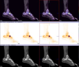 Hybrid Bone SPECT/CT imaging of the Foot and Ankle: Potential Clinical Applications in Foot Pain 22