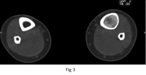 Monostotic Fibrous Dysplasia of Left Tibia by Dr Shekar Shikare, HOD & Consultant, Nuclear Medicine & Dr. Milind Raje, Consultant Radiology, NMC Royal Hospital Sharjah