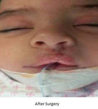Special case of Cleft lip repair in a 9 months old baby girl” by Dr. Wissam Altamr, Specialist, Paediatric Surgery at NMC Royal Hospital, Sharjah 