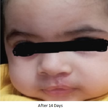 Special case of Cleft lip repair in a 9 months old baby girl” by Dr. Wissam Altamr, Specialist, Paediatric Surgery at NMC Royal Hospital, Sharjah 