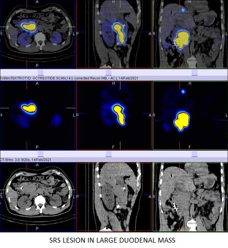 The value of whole body scintigraphy using (99M)Tc-HYNIC-TOC (Tektrotyd) and with single photon emission computerized tomography (SPECT/CT hybrid imaging) in the detection of primary and metastatic neuroendrocrine tumor (nets)