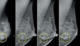 Reshaping the Mammography Experience