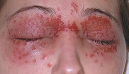 Eczema/Atopic Dermatitis