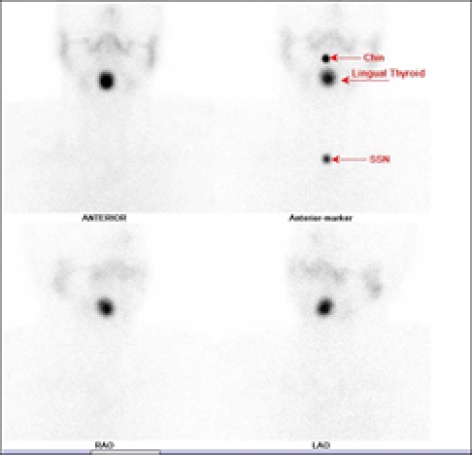 CASE OF THE WEEK – “Thyroid Scintigraphy And Usefulness Of Spect-ct Fused Imaging In Adult Hood With Missing Thyroid Gland ” by Dr Shekhar Shikare, HOD & Consultant, Nuclear Medicine, NMC Royal Hospital Sharjah