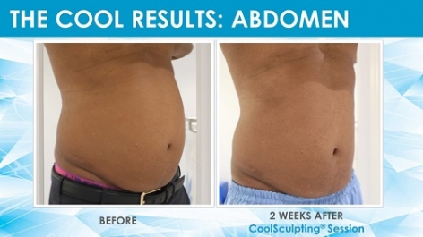 Before & After Results of CoolSculpting: Dr Ricardo Persaud
