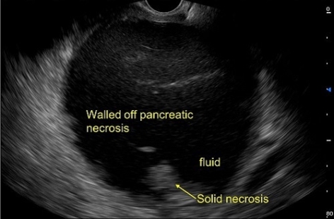 CASES OF THE WEEK – “Endoscopic Ultrasound guided drainage of large walled off pancreatic necrosis (Pseudocyst with solid necrosis) with metallic AXIOS stent” by Dr Piyush Somani, Specialist Gastroenterology
