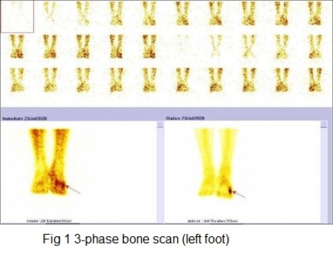 CASES OF THE WEEK - “Bone scintigraphy in osteomyelitis (non-violated bone)” by Dr ShekharShikare, Consultant & HOD, Nuclear Medicine, NMC Royal Hospital Sharjah