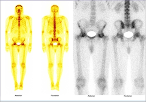 CASE OF THE WEEK – “Case of systemic lupus erythematosus (SLE) with severe low back pain radiating to both the gluteal regions & whole body and hybrid SPECT CT bone scintigraphy showing elevated Sacroiliac Joint Uptake Ratios (Sacroilitis) & clinically occult bilateral avascular necrosis of both the femoral heads (Case report) )”  by Dr. Shekhar Shikare, Consultant, Nuclear Medicine, Dr. Bobby Jose, HOD & Specialist, Neurosurgery & Clinical Administrator, Dr. Milind Raje, Consultant, Radiology and Dr. Deepak Bhatia, Specialist, Orthopaedic Surgery at NMC Royal Hospital Sharjah