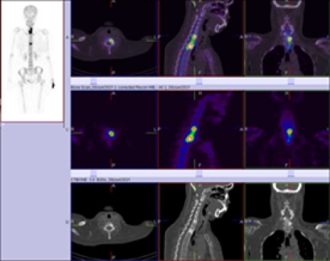 CASE OF THE WEEK – “The black Ivory vertebrae sign on Bone scintigraphy and usefulness of hybrid SPECT CT imaging” by Dr. Shekhar Shikare, HOD & Consultant, Nuclear Medicine at NMC Royal Hospital Sharjah
