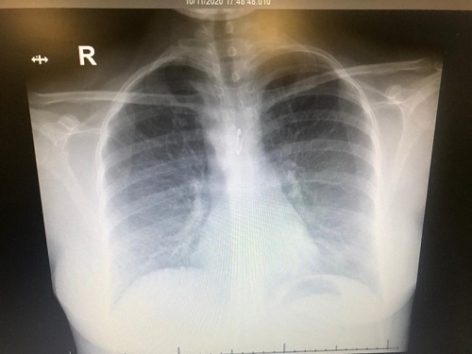 CASES OF THE WEEK – “Emergency foreign body removal (safety pin) lodged in wall of the trachea of a 35 years old female” by Dr Ahmed ElMansoury, Consultant, Pulmonology