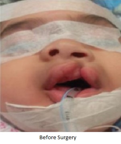 CASE OF THE WEEK – “Special case of Cleft lip repair in a 9 months old baby girl” by Dr. Wissam Altamr, Specialist, Paediatric Surgery at NMC Royal Hospital, Sharjah
