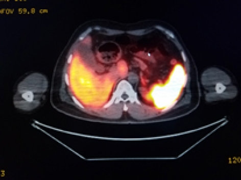 CASE OF THE WEEK – “Hybrid SPECT-CT somatostatin-receptor scintigraphy with 99mTc-Tektrotyd in follow up of post-operative neuroendocrine tumor of 3rd part of duodenum (unusual site) with liver metastases” by Dr Shekhar Shikare, HOD & Consultant, Nuclear Medicine, NMC Royal Hospital Sharjah