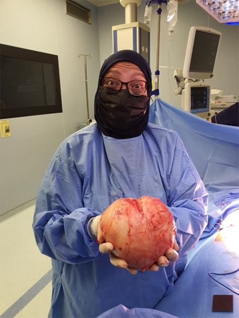 CASE OF THE WEEK – “Case of removal of big Intramural fibroid (around 26-28 weeks fetus sized, weighing 1.1 kg) in 35 years old Palestinian woman” by Dr. Mona Azmy, Specialist Obstetrician and Gynaecologist, NMC Royal Hospital Sharjah